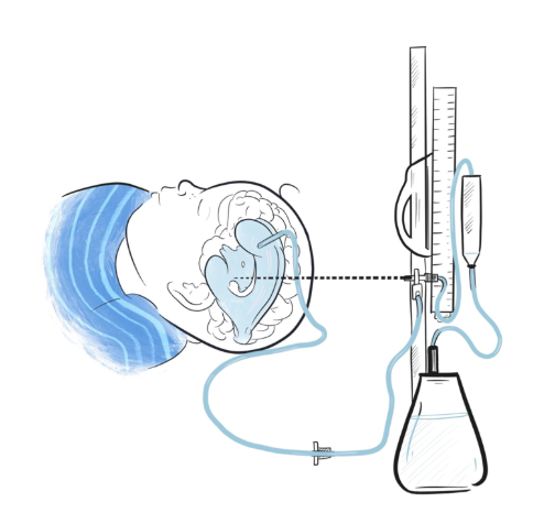 48. Here is a beautiful illustration by  @Merlin_Draws showing you what an EVD typically looks like. To find out more about what an EVD is after the CBD, or watch an insertion click these links! Info:  https://brainbookcharity.org/external-ventricular-drain/Video:  #BBHCP