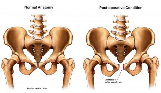 Типы строения таза. Остеотомия таза по солтеру. Скелет женского таза. Расширенный таз. Расхождение костей малого таза при беременности.