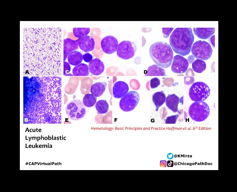 DocBarbieMD's tweet image. Hematopathology!! 🥰. Today’s CAP rapid 🔥 board review. I can’t wait to do a rotation and fellowship in Hempath! Thank you @KMirza for this lecture! #CAPVirtualPath #pathology #hempath