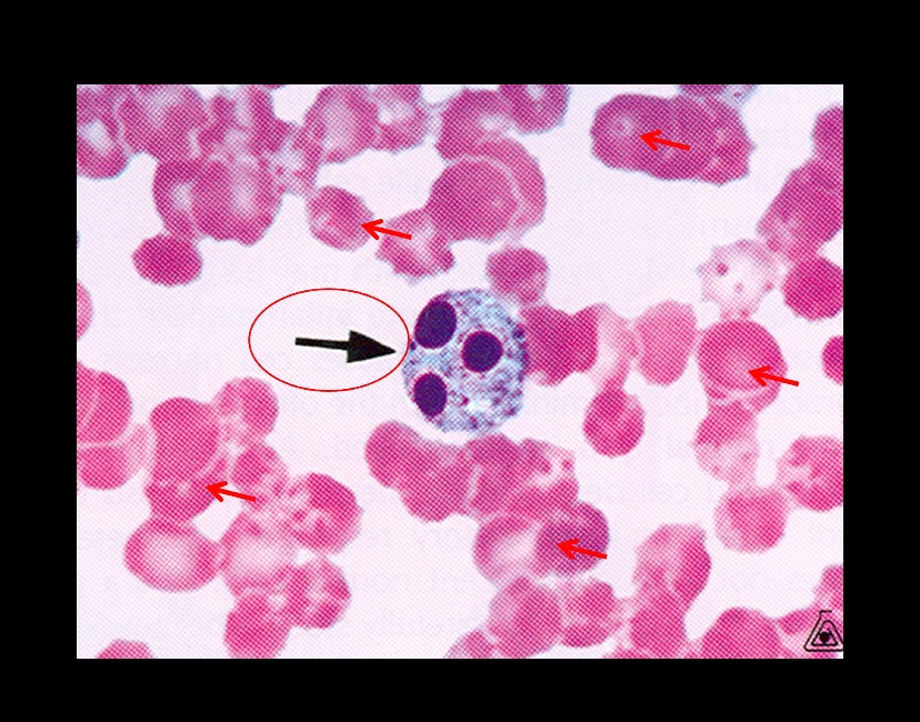 DocBarbieMD's tweet image. Hematopathology!! 🥰. Today’s CAP rapid 🔥 board review. I can’t wait to do a rotation and fellowship in Hempath! Thank you @KMirza for this lecture! #CAPVirtualPath #pathology #hempath