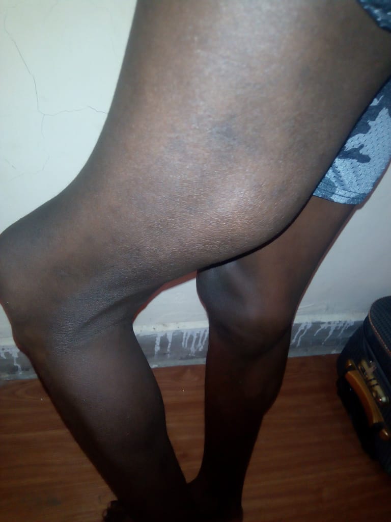 clinton_otunga's tweet photo. #recognizeorthotrauma
Nyikwa Ramogi Ajwang', ogandwa mathoth thagore bang yudo ajali, ka gi yudo thieth koya kuom jok maok olony esektano.
Serikal, kodo ministry mar thieth ok oyangowa kaka jo-orthotrauma. 
@ramogifm,@lakevictoriafm.@sunsetfm https://t.co/e0RnHcxqUm