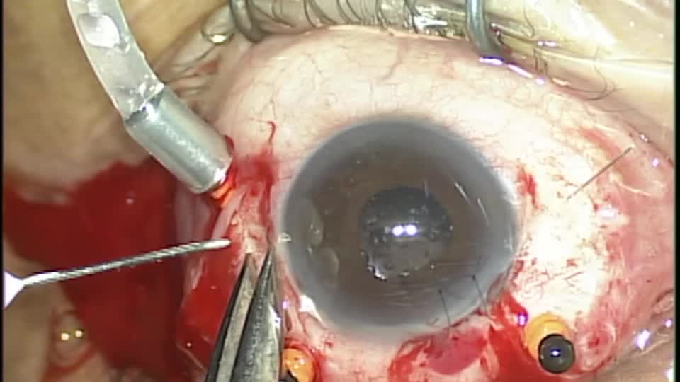 eyetubenet's tweet photo. Thiago Siqueira Rocha, MD, presents a video of a patient with a #DislocatedIOL. A posterior vitrectomy with scleral fixation was performed. https://t.co/fan78LV2Fw https://t.co/V5kfnwoy5p