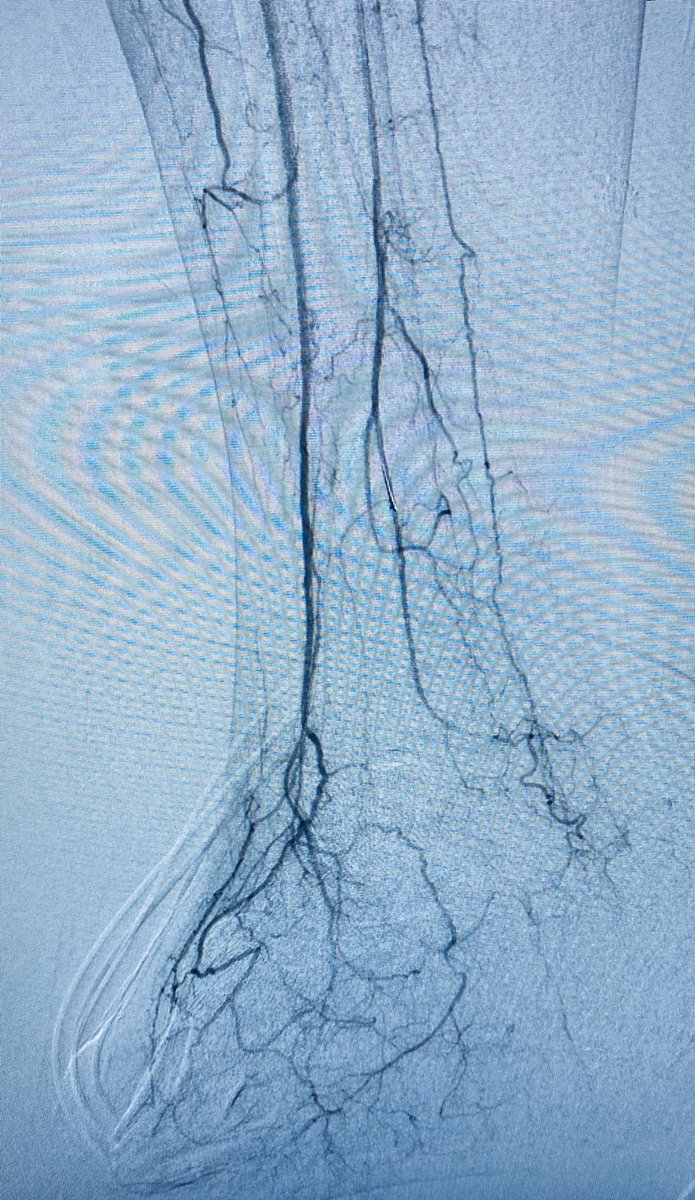 Carlos Guevara MD, FSIR (@carlosguevarair) on Twitter photo #CLIfighters Forefoot gangrene, prior revascularization and told BKA only option (occluded distal SFA-prox tibials), Podiatry+IR collaboration, TMA and revasc @Saukalaka <a href="/ZagumBhatti/">Zagum Bhatti MD</a> <a href="/WashUIR/">Mallinckrodt IR</a> <a href="/SDhandMD/">Sabeen Dhand</a> <a href="/saherssabri/">Saher Sabri</a> <a href="/JVIRmedia/">JVIR</a> <a href="/LessneVIR/">Mark Lessne, MD</a> <a href="/SIRspecialists/">Society of Interventional Radiology</a> <a href="/MoonJustaniah/">Almamoon Justaniah,MD, FSIR المأمون إبراهيم جستنيه</a> <a href="/CHICKVIR/">Jeffrey F. B. Chick, MD, MPH</a> #CLIfighters Forefoot gangrene, prior revascularization and told BKA only option (occluded distal SFA-prox tibials), Podiatry+IR collaboration, TMA and revasc @Saukalaka <a href="/ZagumBhatti/">Zagum Bhatti MD</a> <a href="/WashUIR/">Mallinckrodt IR</a> <a href="/SDhandMD/">Sabeen Dhand</a> <a href="/saherssabri/">Saher Sabri</a> <a href="/JVIRmedia/">JVIR</a> <a href="/LessneVIR/">Mark Lessne, MD</a> <a href="/SIRspecialists/">Society of Interventional Radiology</a> <a href="/MoonJustaniah/">Almamoon Justaniah,MD, FSIR المأمون إبراهيم جستنيه</a> <a href="/CHICKVIR/">Jeffrey F. B. Chick, MD, MPH</a>