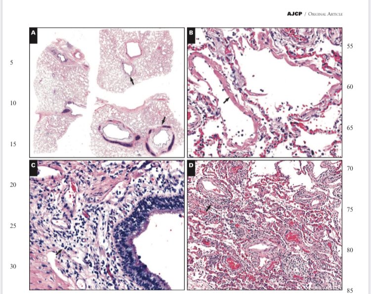 First report of complete autopsies in the English language peer-reviewed literature was just published online in <a href="/AJCPjournal/">AJCP</a> 

Free. Open access. Please read the complete report and share widely. 

#pathology #pulmpath 

academic.oup.com/ajcp/advance-a…