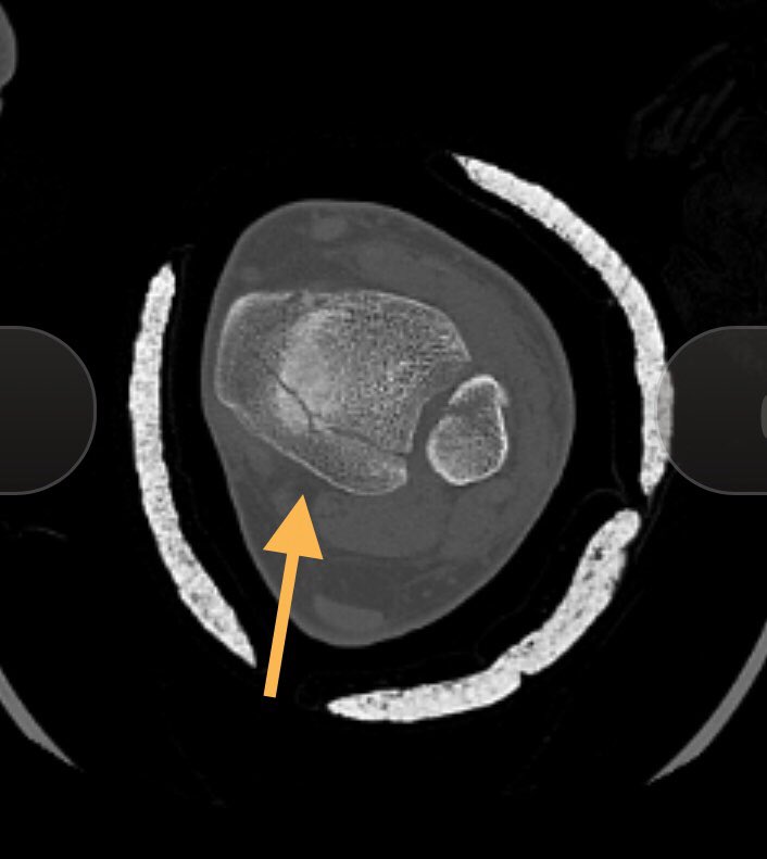 [4/9] Here we can see that the medial malleollus and posterior malleolus are a single fragment (or even if small crack, acting as one). This is Haraguchi type II, which has been shown to have worse outcomes. To learn more about the classification:  https://pubmed.ncbi.nlm.nih.gov/31176480/?from_term=Blom+injury+2019