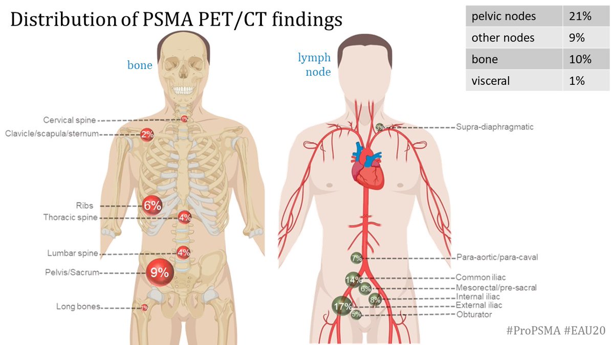8/ Here is the distribution of PSMA PET/CT findings.Lot's of other intesting in the Supplementary Appendix, available online!