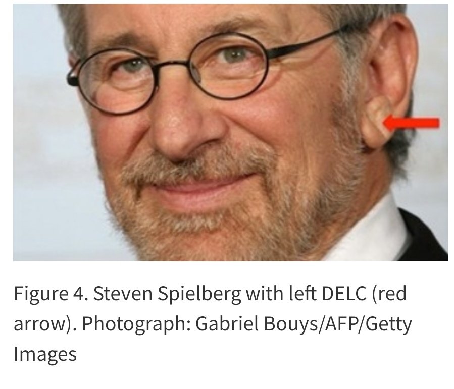almagoch's tweet photo. Sobre el signo de Frank: 
1. Una foto pública de un personaje público que utiliza @StanfordMed 
2. Asociación con enfermedad cardiovascular: S43% E70%
3. EVC: S73% E70%
4. Descrito x Sanders T. Frank 1973
5. Enfermedad microvascular debilita las fibras elásticas del lóbulo https://t.co/FQ2B2WCBWZ