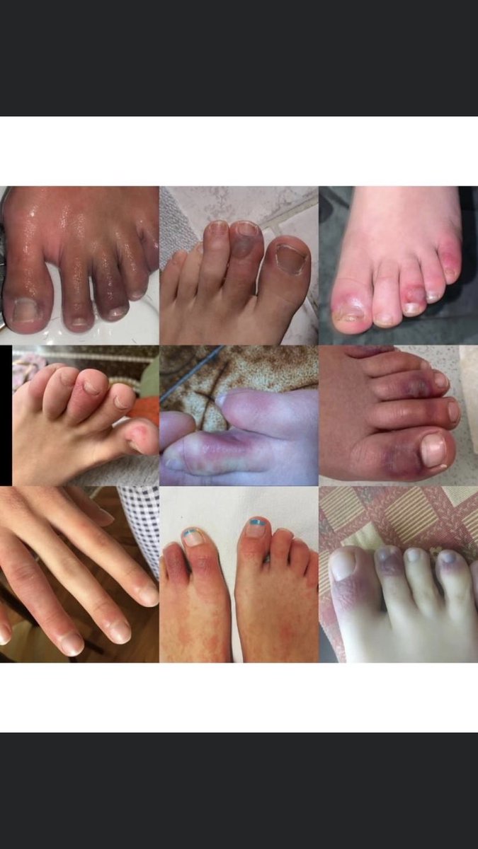 Please be aware there are skin signs of covid. Purple red papules on the fingers and toes. Looks like chilblains/ pernio. May have no other covid symptoms. Seen in young people. Images of pernio like changes of Covid-19 from Italy  @TamarPedsRheum  @NataliaVasCan  @IreneBlancoMD