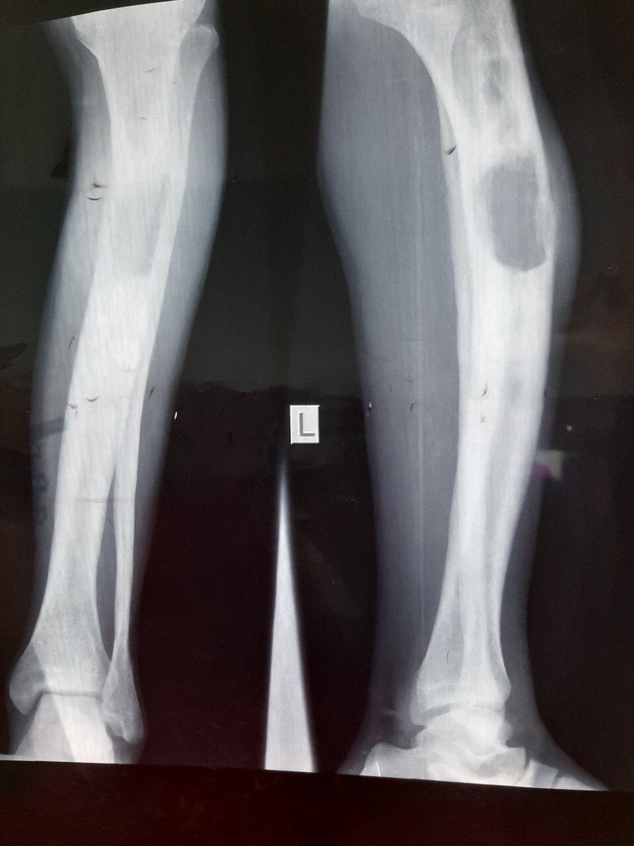  @DrGeeONE  @01sth02  @nusrat_xahra  @Teddy_wub  @SarasSreeram Do we know any rad colleagues that could help us interpreting this please