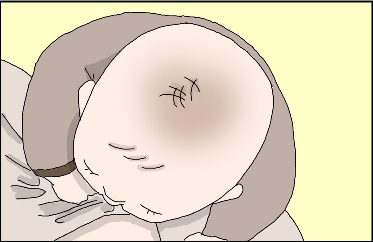ちょっとそこの薄毛ちゃんのママさん!もしくはハゲてる方!
お子ちゃんの心拍数高そうな時に大泉門あたり見てみて下さい。
これあるあるなの?

多分血管があるんだとは思うんですが、皮膚の下でピコピコ…

#育児漫画 #育児絵日記
https://t.co/yF43638TrW 