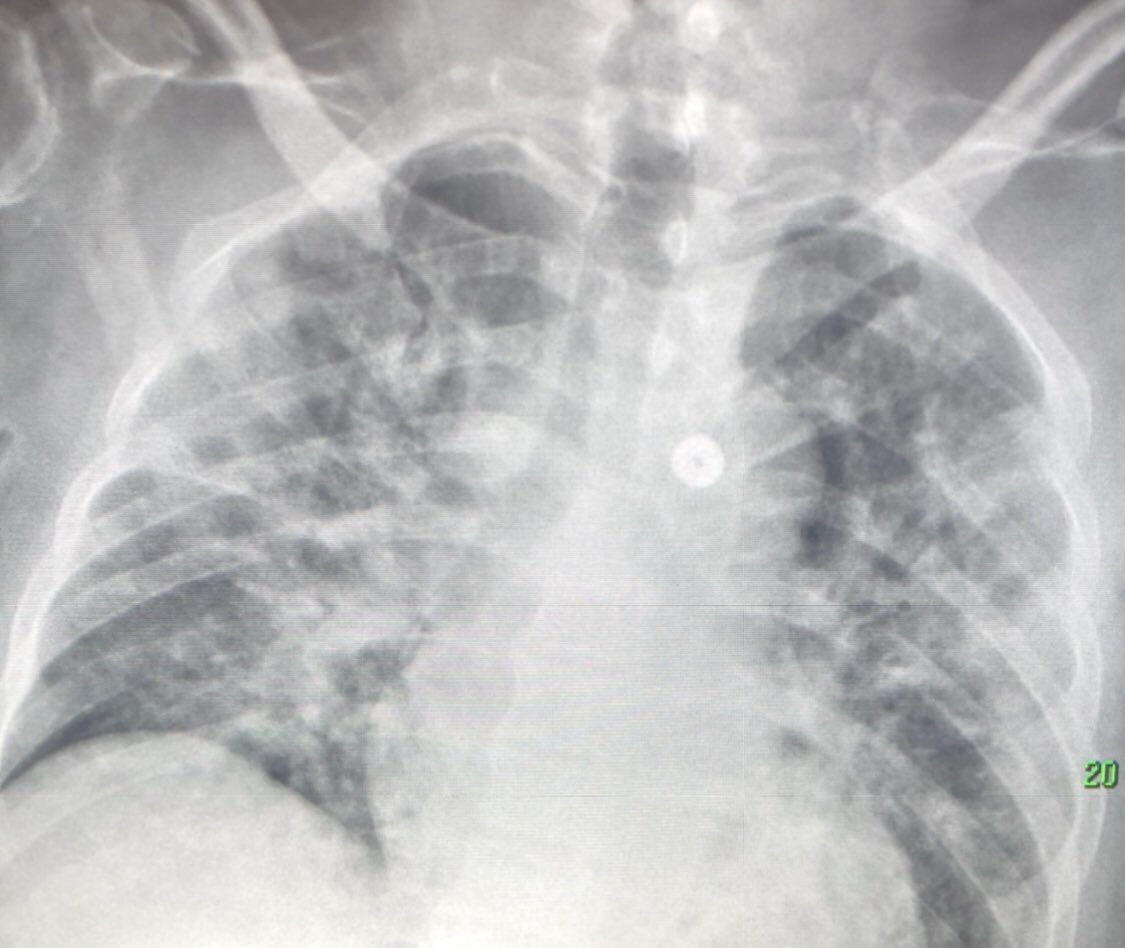 DrSamHare π (@lungdiagnosis) on Twitter photo Finished the 12 hour radiology day shift <a href="/RoyalFreeNHS/">Royal Free London</a> <a href="/BarnetED/">Barnet ED</a> <a href="/NHSEngland/">NHS England</a> please continue to stay at home this Easter ππ» #StayHomeSaveLifes β
Finished the 12 hour radiology day shift <a href="/RoyalFreeNHS/">Royal Free London</a> <a href="/BarnetED/">Barnet ED</a> <a href="/NHSEngland/">NHS England</a> please continue to stay at home this Easter ππ» #StayHomeSaveLifes β