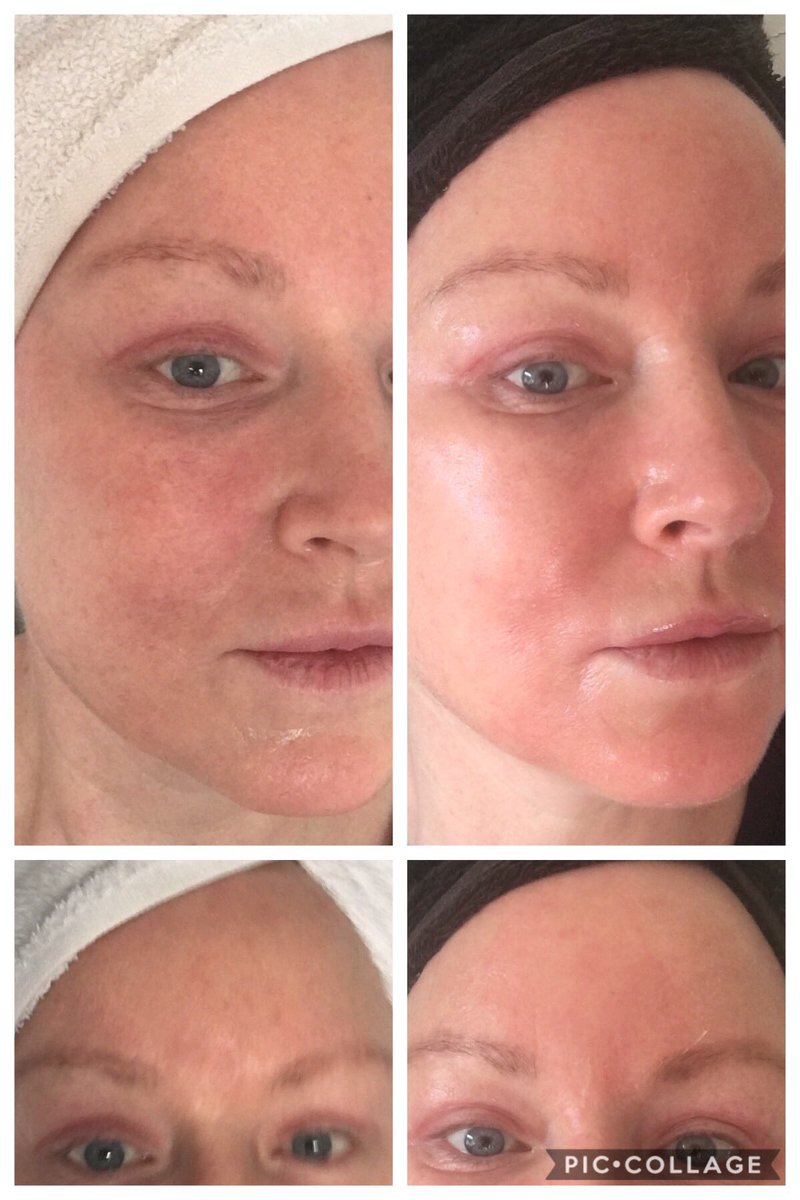 See my improvement in pigmentation from my Zein Obagi home peel over 5 days . #homepeel