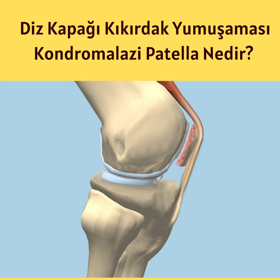 kondromalazi - Twitter Search