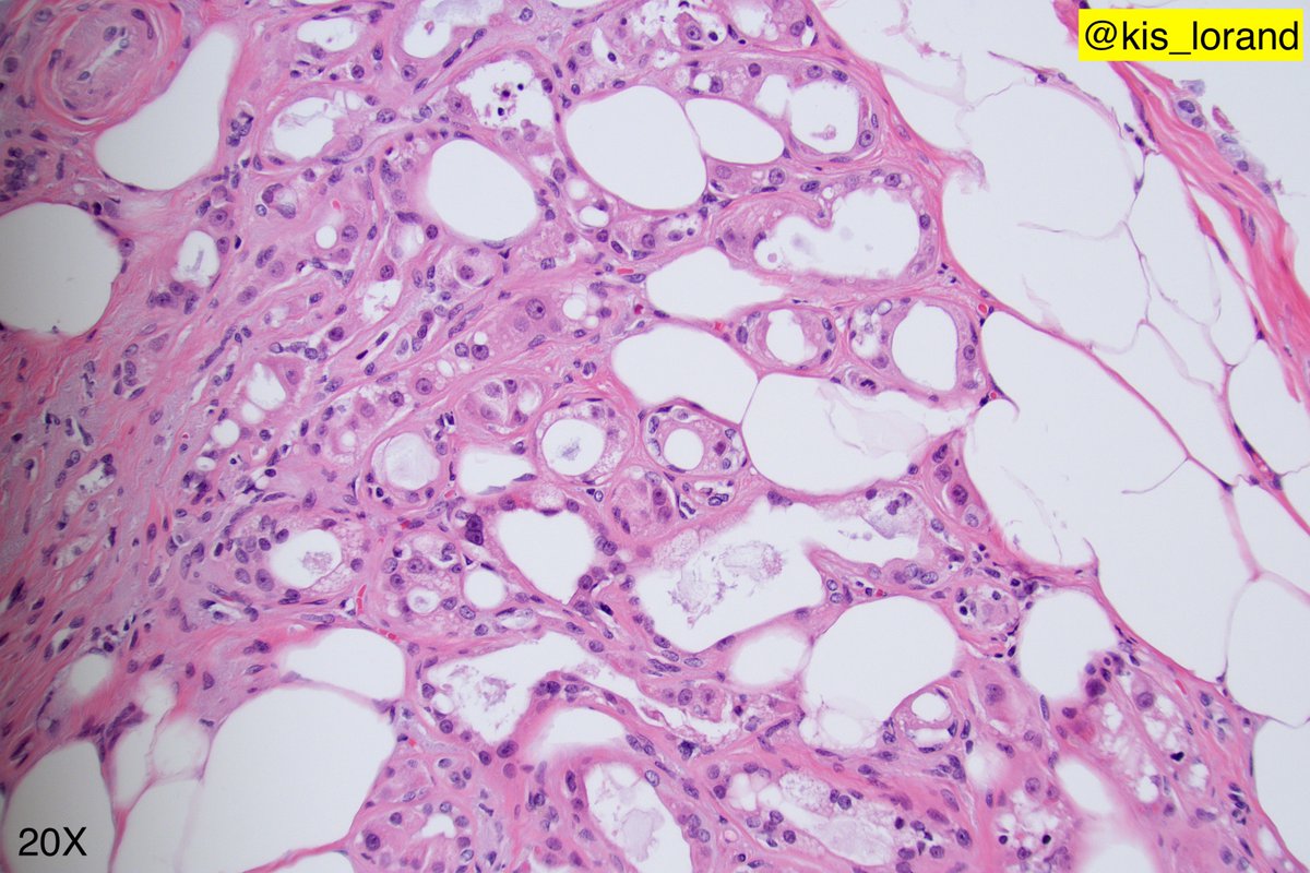 One more breast lesion some IHCs in the thread...Your thoughts on this one? #breastpath  #pathology  #IHCpath