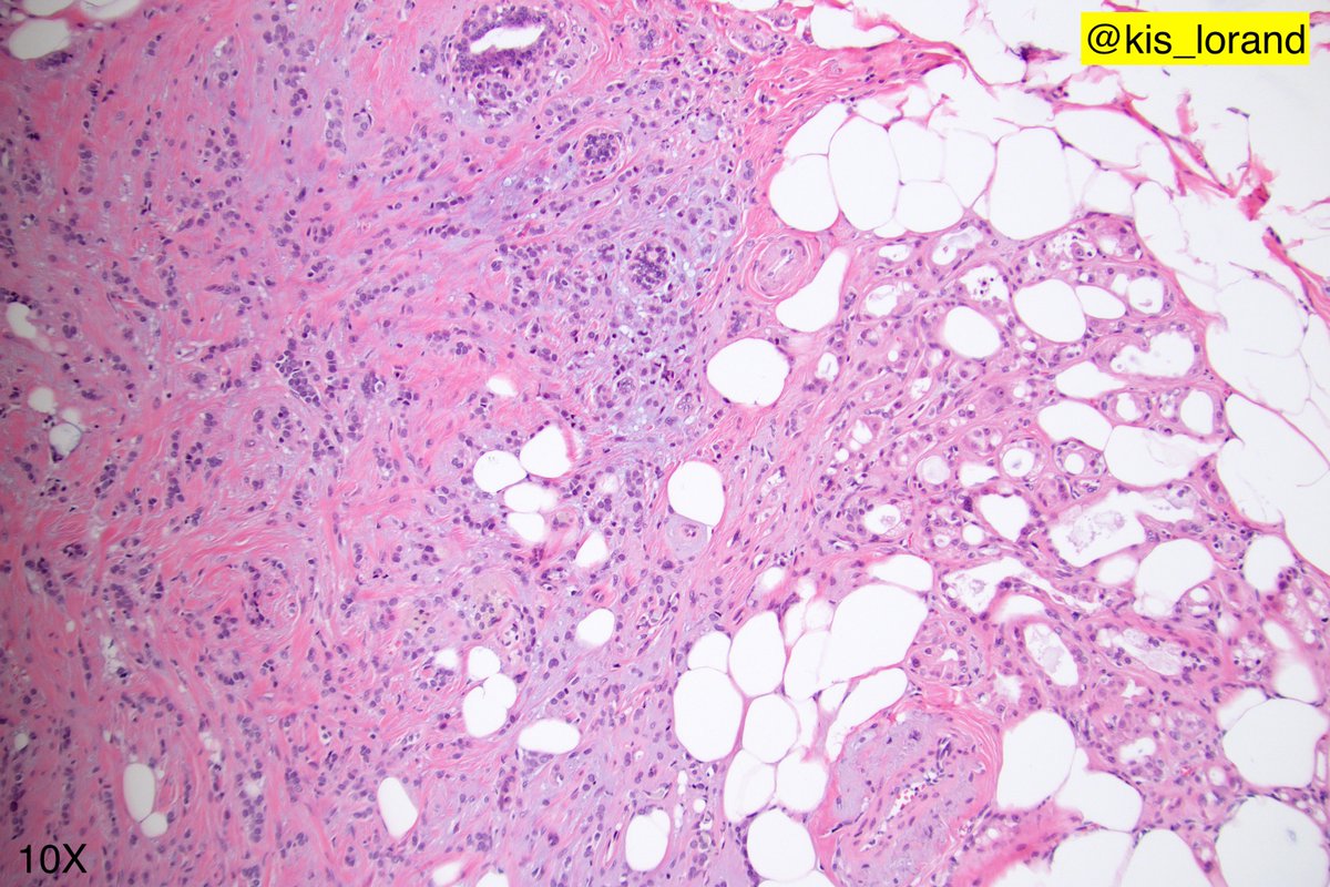 One more breast lesion some IHCs in the thread...Your thoughts on this one? #breastpath  #pathology  #IHCpath