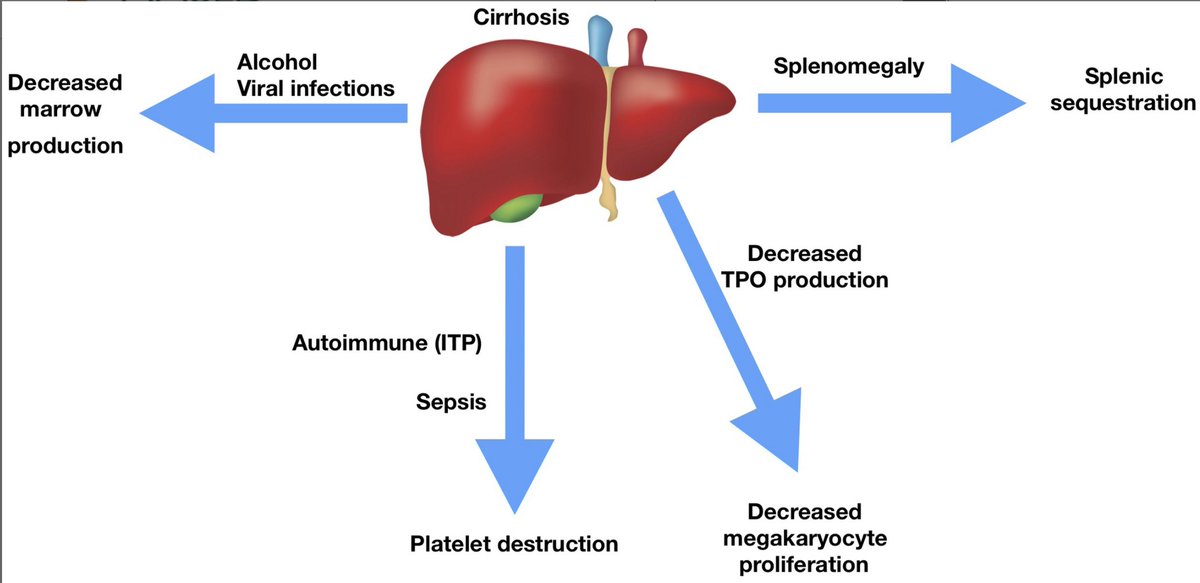 First up, thrombocytopenia! The potential mechanisms are laid out in the image below ( https://aasldpubs.onlinelibrary.wiley.com/doi/full/10.1002/cld.860):- decreased thrombopoietin production- sequestration- alcohol/viral causes suppressing marrow- peripheral destruction