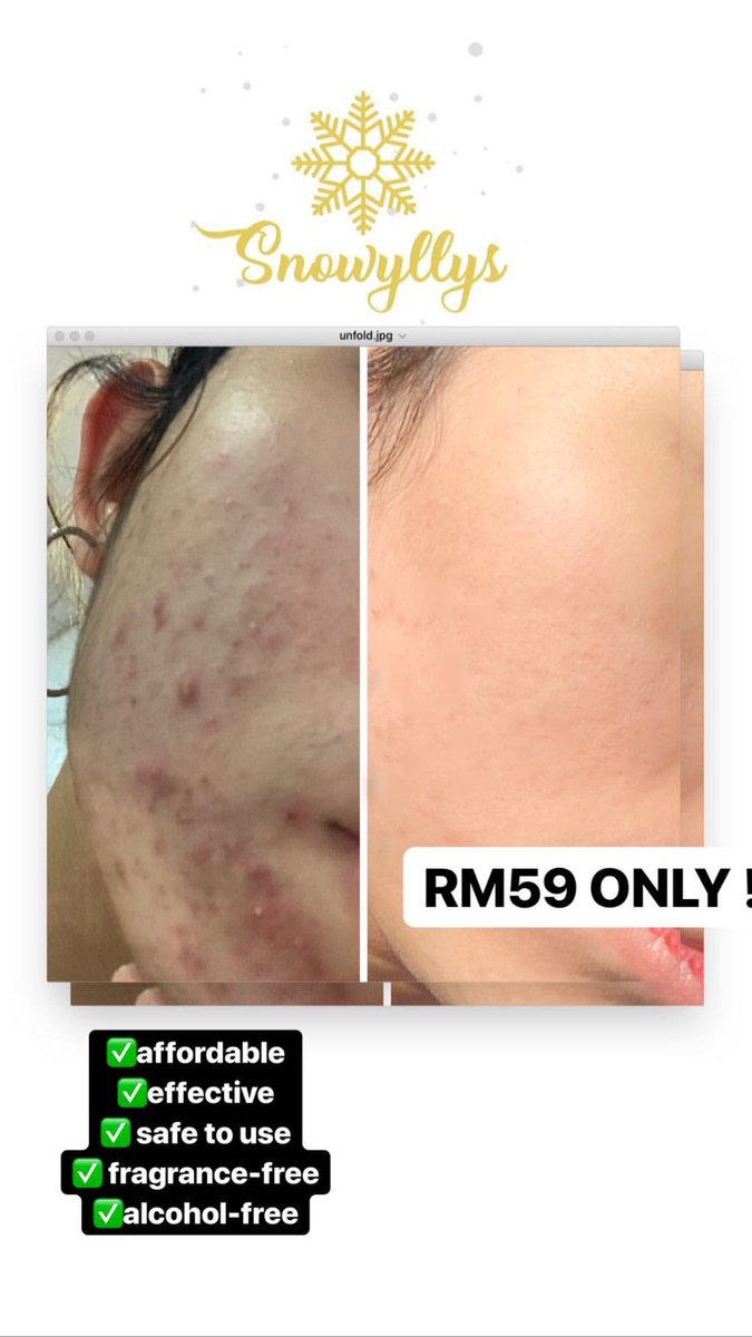 snowyllys's tweet photo. [PKP SALES] RM40 FREE POSTAGE  
🌡lighten your scars
🌡Brighten your skin 
🌡FLAWLESS WITHIN 7 DAYS 

ORDER NOW 
https://t.co/zwhhuk8nQZ https://t.co/Uw3SzGVS2Q
