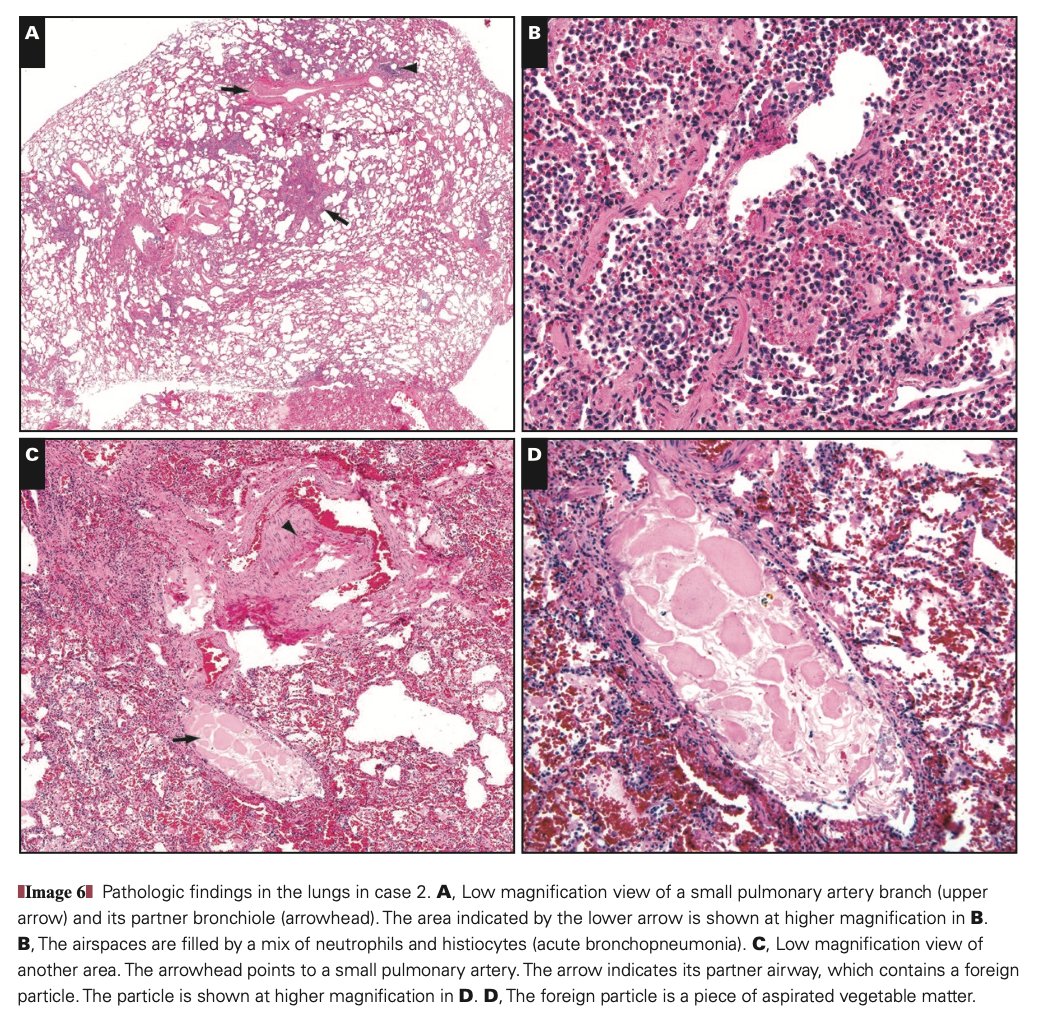 En el caso 2 (fallecido CON COVID19) muestra los hallazgos clásicos de la neumonía aspirativa, incluido material vegetal (abajo derecha)