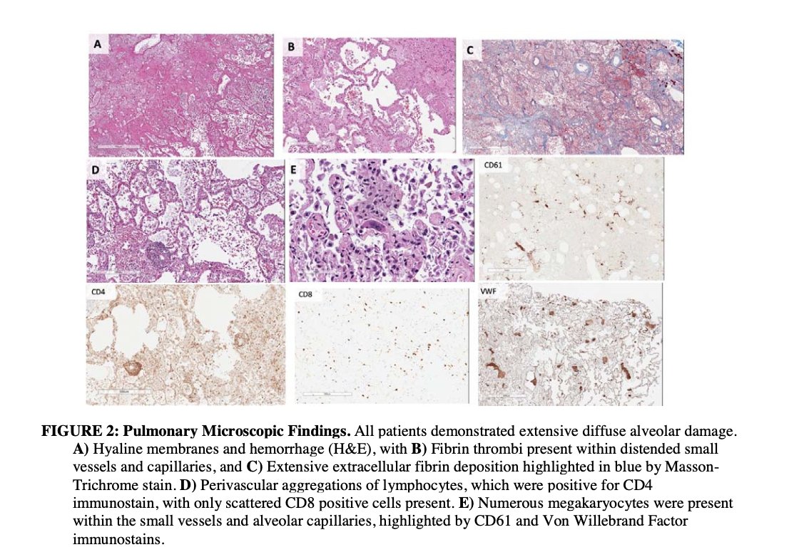 Las muestras microscópicas evidenciaron signos de DAD con descamación de neumocitos, infiltrado linfocitario CD4+, hemorragia intraalveolar y formación de membranas hialinas. También observan un trombo de fibrina en vaso (imagen B)