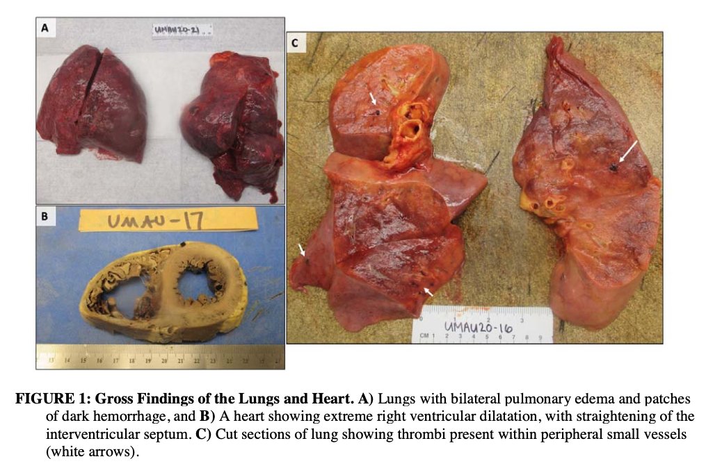 La apariencia macroscópica de los pulmones mostró edema y focos hemorrágicos en los 4 pacientes. En algunos casos (no dicen cuantos) se apreciaron algunos trombos en vasos pulmonares (figura derecha). Junto a ello cor pulmonale (figura abajo izquierda)