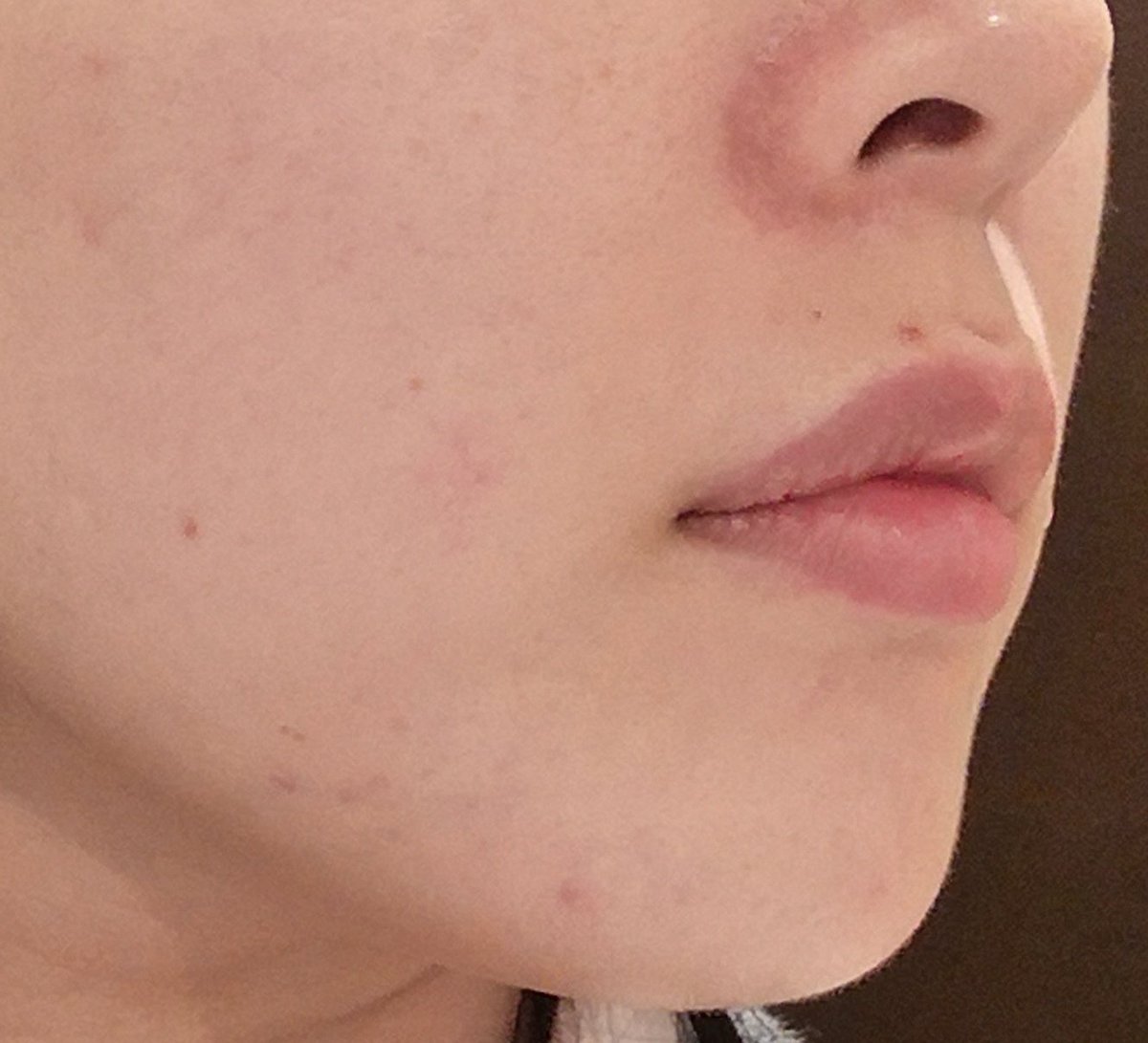 ましろ Tren Twitter 続 ベピオゲル 生活91 152日目 あ 久々に小鼻脇に怪しい気配 赤み出てるので本日はべピオ塗ります ニキビの芽は早めに摘み取りたいですね ニキビ引いたらまたべピオお休みします