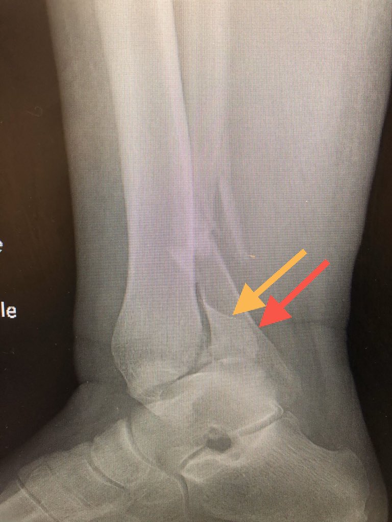 [1/9] My mentor once said “if you can understand ankles, you can understand all of orthopaedics.” You can tell this ankle will be trouble due to fibula comminution. On lateral can see great example of how fibula (red) travels with posterior mal (yellow) because they’re attached.