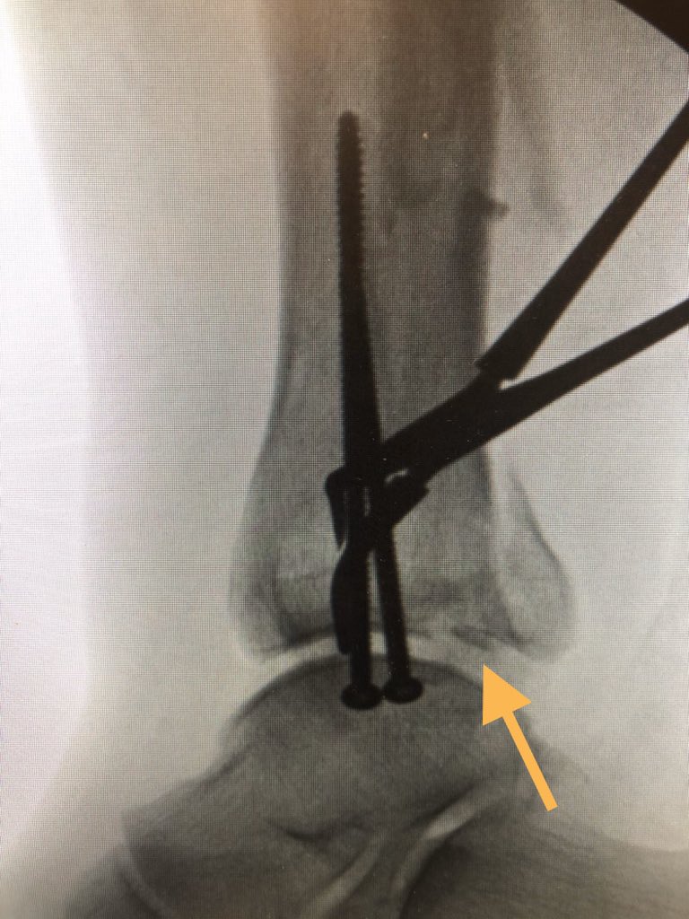 [3/9] Because of other injuries patient could not go prone, so CT doesn’t add anything at this point because I know my approach will be supine and therefore percutaneous. Here after medial mal fixed, you can see some comminution at the joint but that the posterior mal is small.