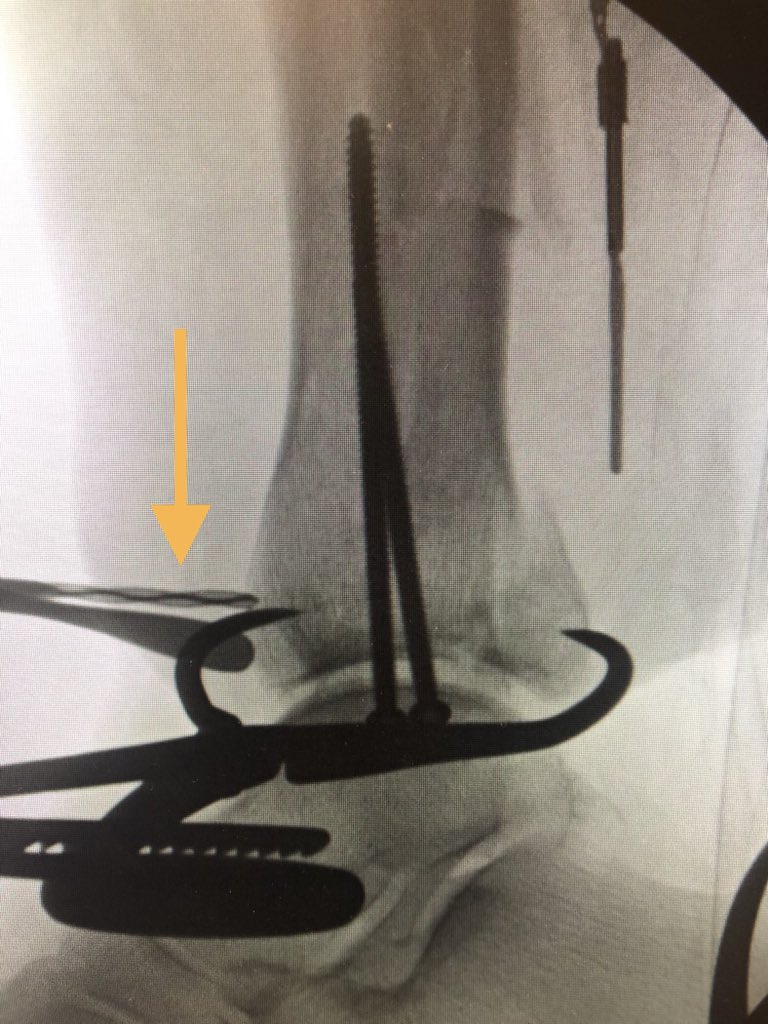 [5/9] I decided that even though the piece was smaller than I had thought, fixing it would help with stability and potentially avoid syndesmotic screws. So I clamped from front to back, with the back tine lateral to Achilles (assumed this was haraguchi 1 which is most common).