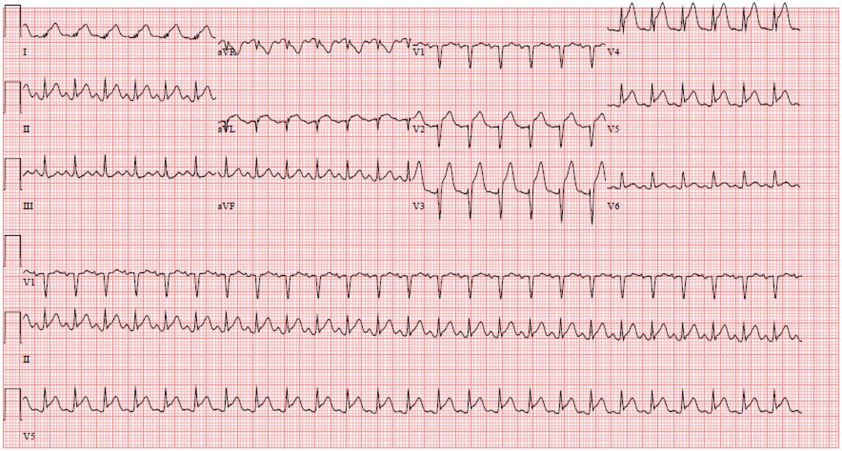 Jeremy Slivnick (@jslivnickmd) on Twitter photo COVID-19 "STEMI" today. EKG with anterior and lateral ST elevations. Clean coronaries. Echo shows apical wall motion abnormality and possible LV thrombus. Stress cardiomyopathy or myopericarditis? Thoughts? cath and #echofirst below. <a href="/DrQuinnCapers4/">Quinn Capers, IV</a> <a href="/OSUCardioOnc/">R.R. Baliga, MD</a> <a href="/SaurbhRajpal/">Saurabh Rajpal</a> COVID-19 "STEMI" today. EKG with anterior and lateral ST elevations. Clean coronaries. Echo shows apical wall motion abnormality and possible LV thrombus. Stress cardiomyopathy or myopericarditis? Thoughts? cath and #echofirst below. <a href="/DrQuinnCapers4/">Quinn Capers, IV</a> <a href="/OSUCardioOnc/">R.R. Baliga, MD</a> <a href="/SaurbhRajpal/">Saurabh Rajpal</a>