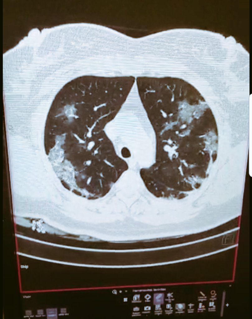 ricardo_bedon's tweet photo. Hace 1 semana atendía a una 👩🏽 de 40 años, 38.9 C, dolor abdominal y eritema conjuntival. SIN síntomas respiratorios, auscultación pulmonar normal. PCR + para #Covid_19 👇🏽 https://t.co/e4kKpxrWH7