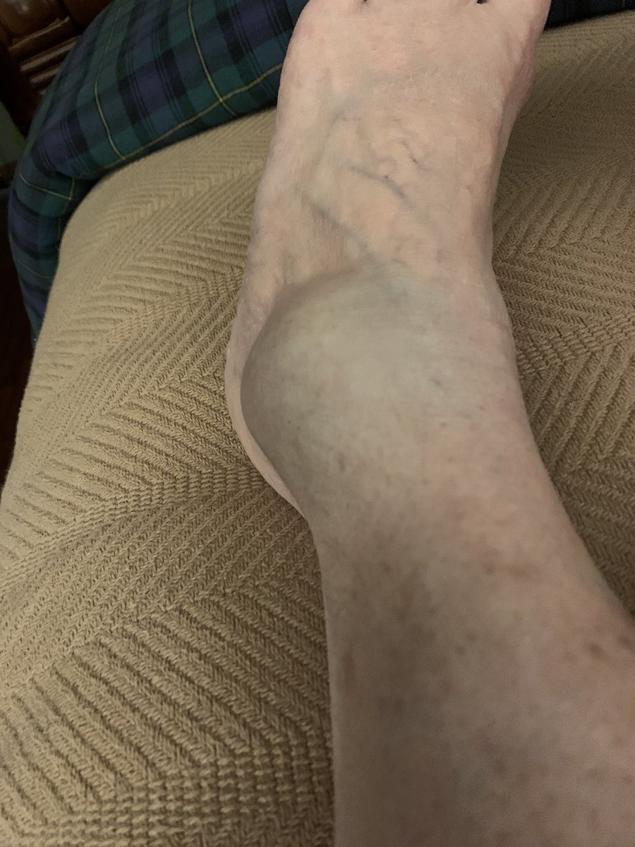 cldilla's tweet photo. Stay home, they said. Stay safe, they said. Sit on the couch, they said. What happens when you sit too long? Ever try to walk when your foot is asleep?
Don’t go to the hospital, they said...#rolledit https://t.co/wZd9X3kyuR