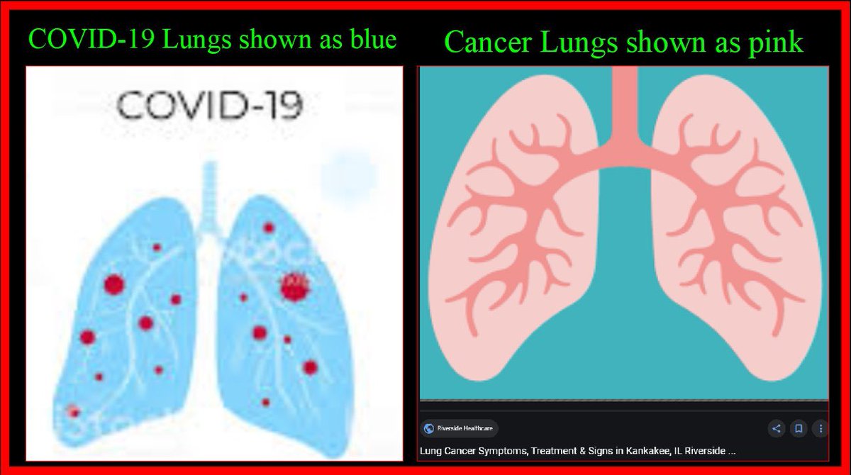 “They are tricking you by depicting the lungs of COVID-19 patients as blue.            #StopChinaVirus It's a fungal infection & why HDQ works. A ventilator w/o HDQ pumps O2 straight to fungus (aerobic respiration)CO2 is byproduct  #BlueLungVirus “  #TruthForce