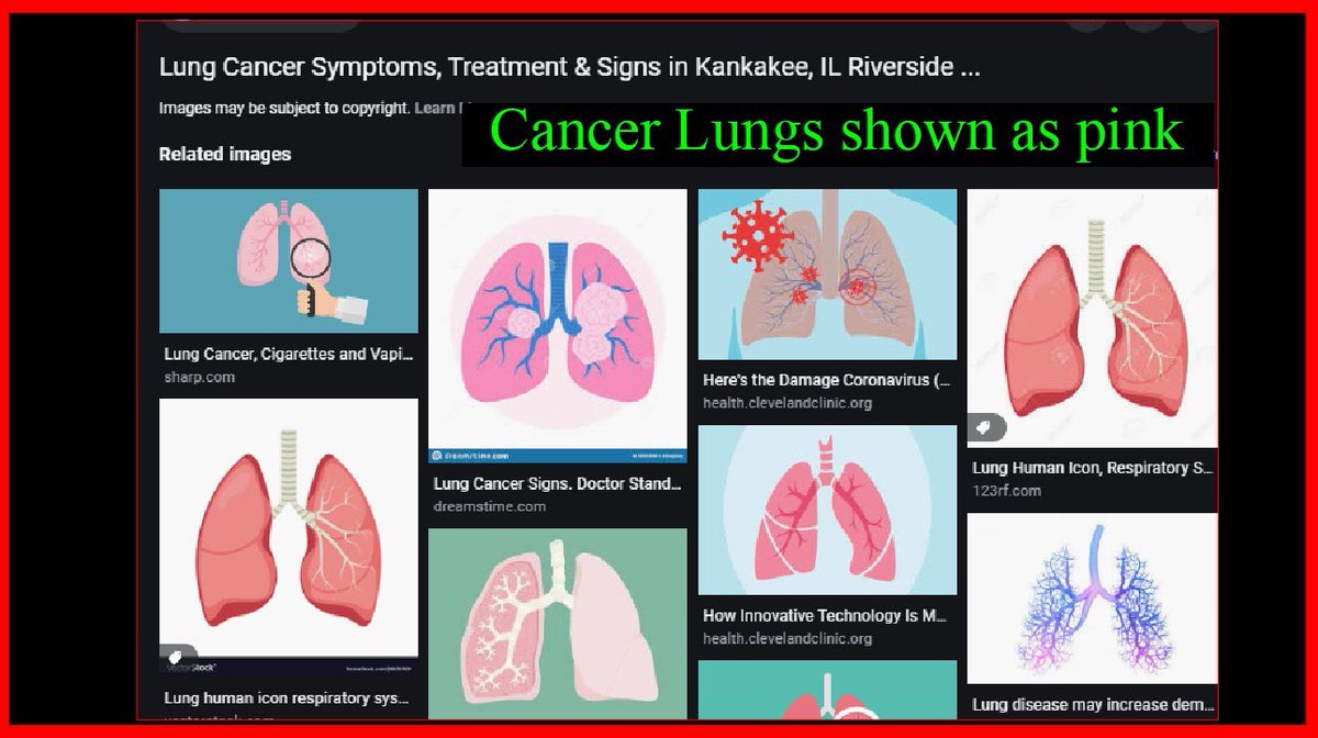 “They are tricking you by depicting the lungs of COVID-19 patients as blue.            #StopChinaVirus It's a fungal infection & why HDQ works. A ventilator w/o HDQ pumps O2 straight to fungus (aerobic respiration)CO2 is byproduct  #BlueLungVirus “  #TruthForce