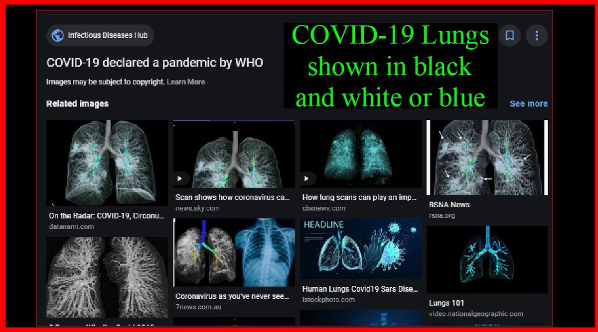 “They are tricking you by depicting the lungs of COVID-19 patients as blue.            #StopChinaVirus It's a fungal infection & why HDQ works. A ventilator w/o HDQ pumps O2 straight to fungus (aerobic respiration)CO2 is byproduct  #BlueLungVirus “  #TruthForce