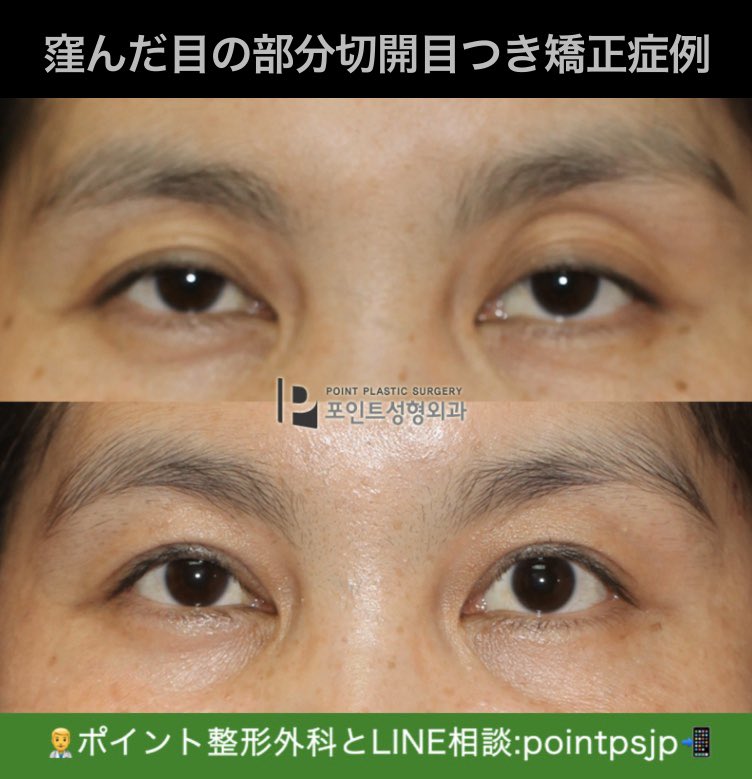 ポイント整形外科 Before After ケース 左右非対称が酷く 眠そうに見える目です まぶたの窪みが酷くて年齢よりも老けて見えます 手術プラン 部分切開目つき矯正 まぶたの部分脂肪移植 目が大きくなり 左右非対称だった眉毛の ポイント整形外科 Before After ケース 左右非対称が酷く 眠そうに見える目です まぶたの窪みが酷くて年齢よりも老けて見えます 手術プラン 部分切開目つき矯正 まぶたの部分脂肪移植 目が大きくなり 左右非対称だった眉毛の