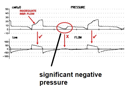 10/11This negative dip may be rather pronounced if the respiratory drive is high (e.g. flow starvation in volume control). This may cause IVC collapsibility per prior discussion.However, I would offer caution in using this for CVP estimation as other factors may affect the IVC