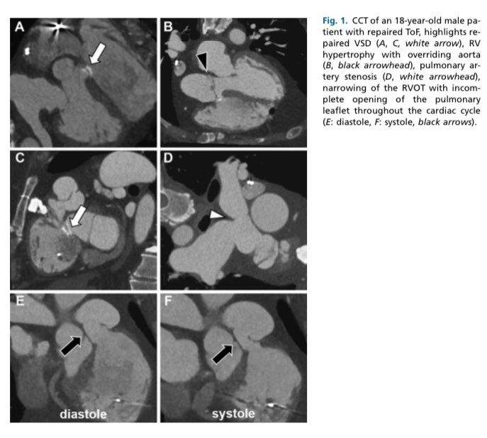 cardiopedhnn's tweet image. La importancia de #whyCCT y #yesCMR en la evaluación postoperatoria de pacientes las principales  cardiopatías congénitas cianoticas. Revisión. 
👉radiologic.theclinics.com/article/S0033-…

#cardiopatiascongenitas #imagencardiaca #CpedSISIAC @SISIACOficial