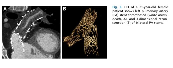 cardiopedhnn's tweet image. La importancia de #whyCCT y #yesCMR en la evaluación postoperatoria de pacientes las principales  cardiopatías congénitas cianoticas. Revisión. 
👉radiologic.theclinics.com/article/S0033-…

#cardiopatiascongenitas #imagencardiaca #CpedSISIAC @SISIACOficial