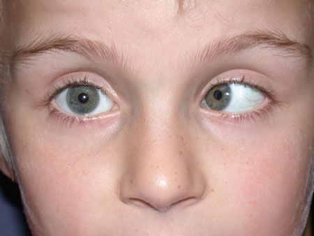 They concluded that he most probably had the eye condition called Strabismus. You know this condition, you just didn't know the name. Here are some pictures. It's sometimes called cross-eye