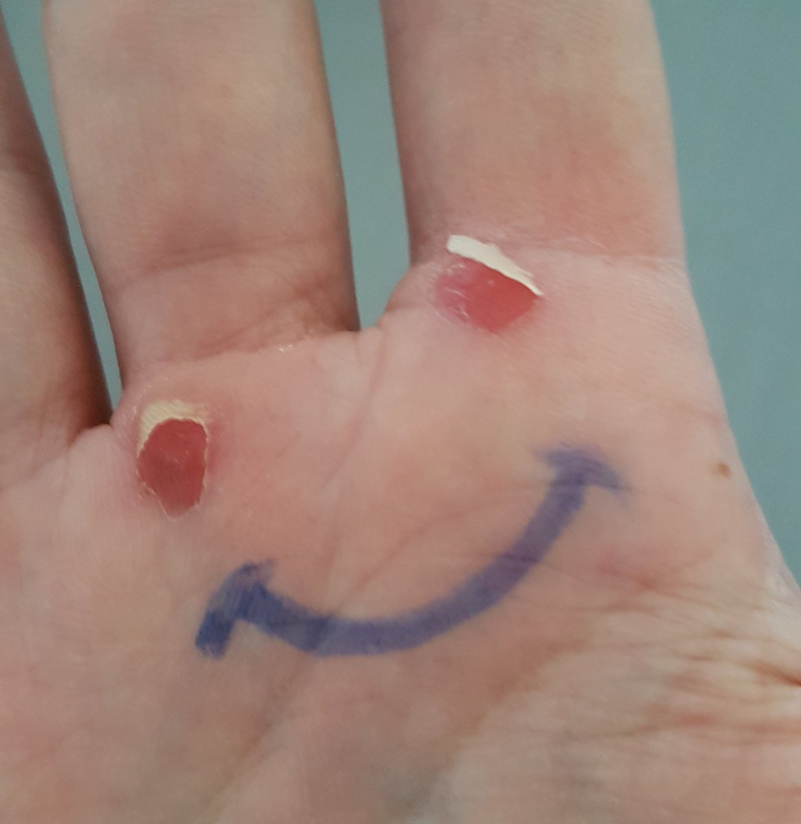 bihan35's tweet photo. Voilà ce qui se passe quand un jardinier du dimanche, travaille trois jours de suite dans le jardin... 😅
#viveleconfinement https://t.co/ElGidw0ZtS