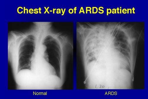 The clinical syndrome that some will develop as a consequence of the viral pneumonia is A.R.D.S (Acute Respiratory Distress Syndrome) which is frequently fatal. Only about 50% of ARDS patients who are placed on a ventilator will survive.  This is how COVID patients die.