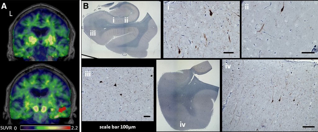 UCSFmac's tweet image. 18 F-flortaucipir (AV-1451) tau PET in frontotemporal dementia syndromes. Limited sensitivity and specificity in patients with FTD and predicted tauopathy or TDP-43 pathology. bit.ly/2V910Vg @RabLab_UCSF @lee_suzee @SalvoSpinaSF @grinberg_t @AlbaLanguage @CoppolaLab