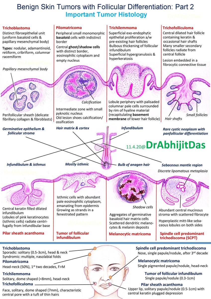 AbhijitSurgPath's tweet photo. Part 2:
What are the different salient points of benign skin tumors with follicular differentiation? Basic histomorphology for residents 

#BasicFactsForResidents 

#MakeSurgiPathEasy 

#SkinTumorsFollicularDifferentiation https://t.co/OQTizfE3Q0