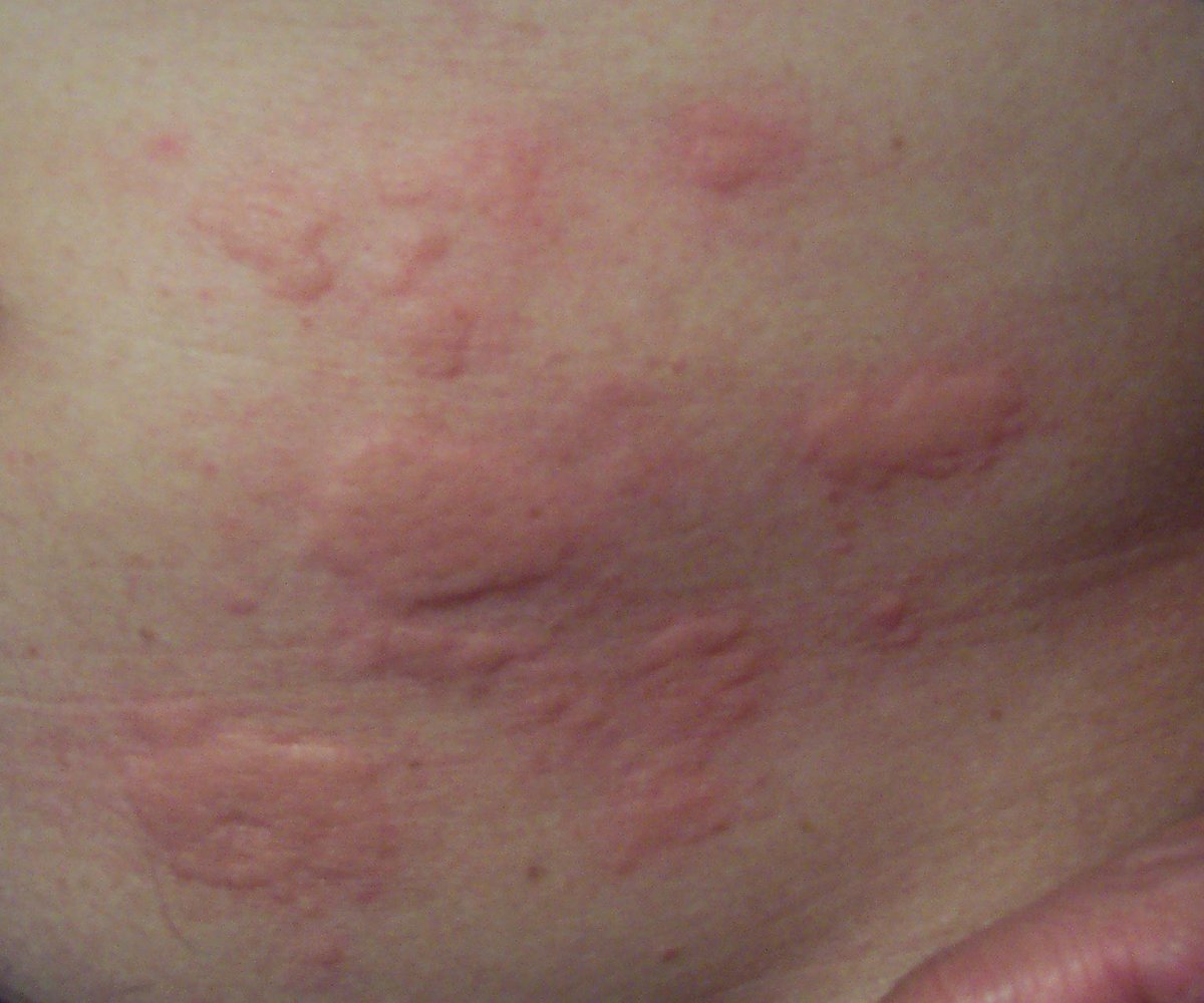 Dr_moji's tweet photo. J’ai vu ce matin une jeune femme de 20 ans avec de l’urticaire diffus qui évolue depuis 48h et résistant au traitement anti histaminique. 
Ces lésions cutanées peuvent correspondre au covid-19. Dans le doute, téléconsultez votre médecin ou dermatologue. https://t.co/X6r9wNjUxj