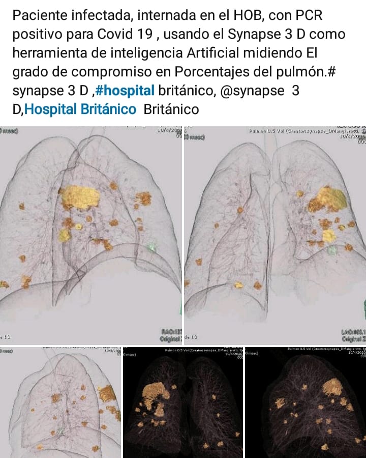 griensu's tweet photo. Evaluación del grado de compromiso en porcentaje de un paciente con Covid19 con la utilización del software de reconstrucción avanzada #Synapse3D de #Fujifilm #Neverstop 
Imágenes compartidas por el Servicio de Diagnóstico por Imágenes del Hospital Británico. https://t.co/s6nIn83yBn
