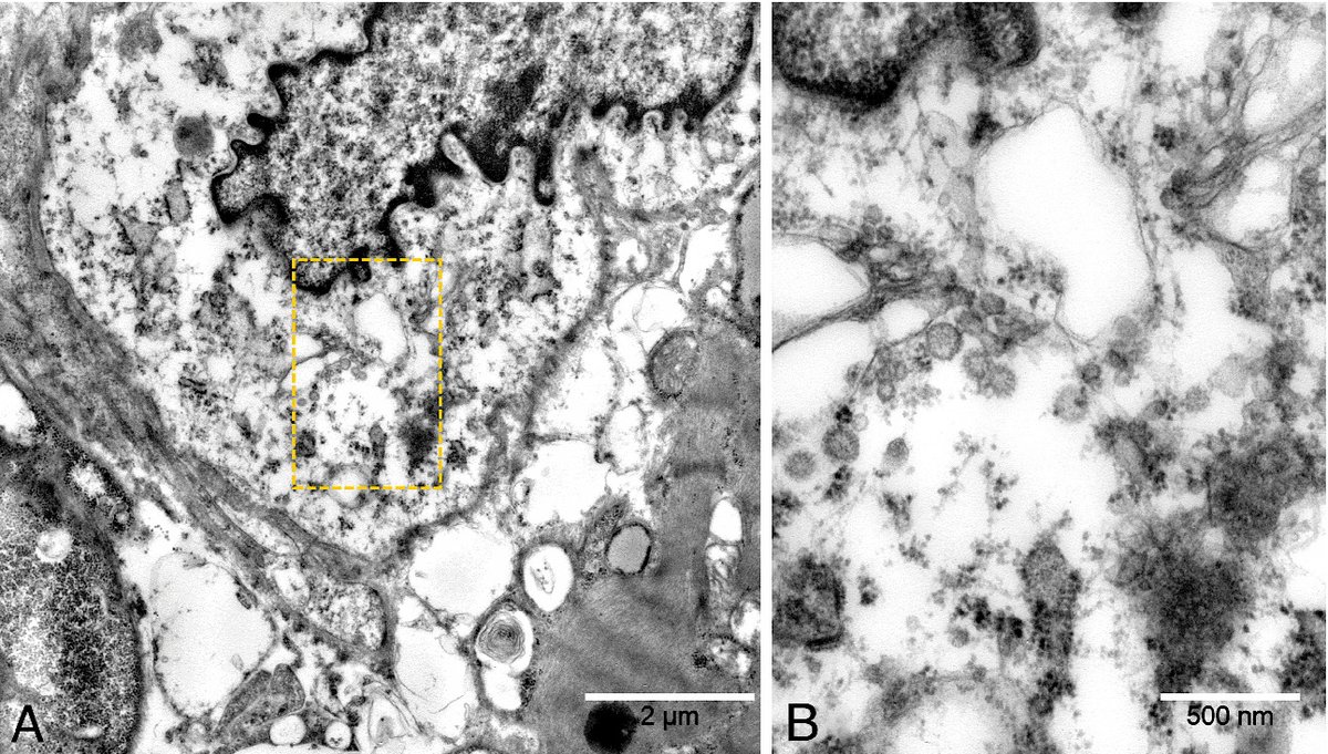 escardio's tweet photo. #COVID19 can be found within myocardial tissue in #CardiogenicShock. Read about this case on #coronavirus 
https://t.co/YCtJtW6HAO

#EJHF @MarcoMetra @kevin_damman @HFA_President #Covid_19 #cardiotwitter https://t.co/EsrvjdBsJ2