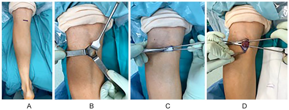 In this prospective randomized trial, patients with recalcitrant plantar fasciitis that underwent surgical treatment with either proximal medial gastrocnemius release or open plantar fasciotomy had similar good clinical results and patient satisfaction. ow.ly/psBX50zcxbh