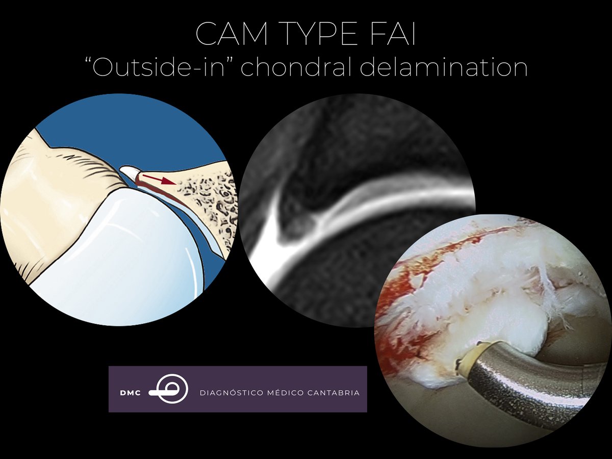 DmcRadiologia's tweet photo. #SMSKfromTheCave 
In FAI, there is a conflict between the acetabular rim and femoral head-neck junction, resulting in chondral and labral injury starting in the periphery of the joint and progressing centrally (‘‘outside-in’’ mechanism) https://t.co/IdDBBujiD8