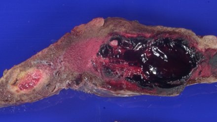 I still have time to prep for my #CAPVirtualPath lecture on placental pathology with serious consequences = here is your opportunity to ask me anything in advance!