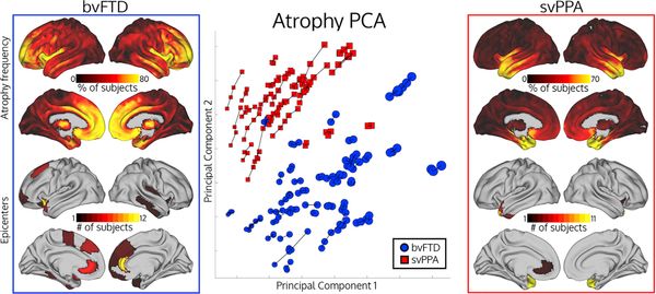 UCSFmac's tweet image. Patient-Tailored, Connectivity-Based Forecasts of Spreading Brain Atrophy. Connectivity-based model can predict longitudinal spread of atrophy. bit.ly/2BAlexC @jesseaaronbrown @lee_suzee @SalvoSpinaSF @grinberg_t  @CoppolaLab